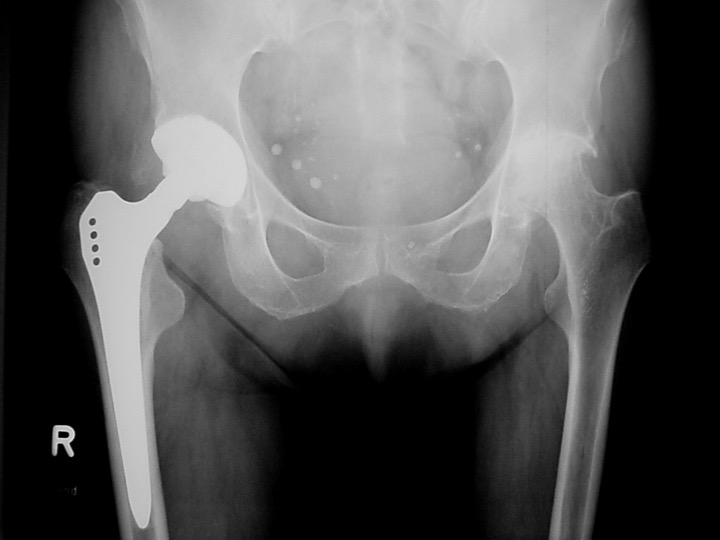 Bindegewebe – Knochengewebe BodyLab Osteopathie Physiotherapie Rehabilitation Training Zürich Coxarthrose Hüft-TP